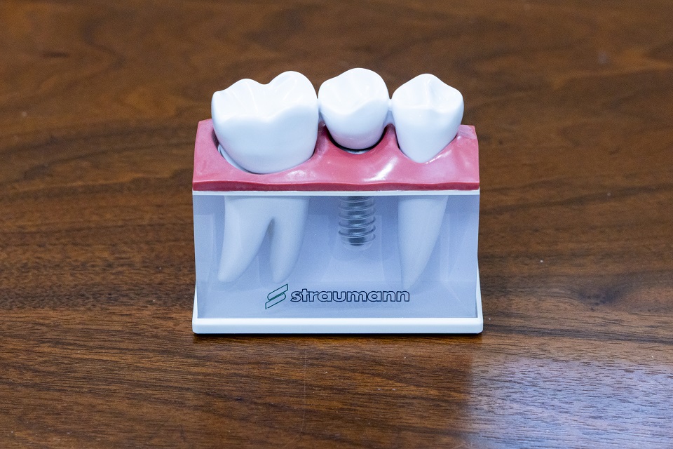 インプラント治療とは